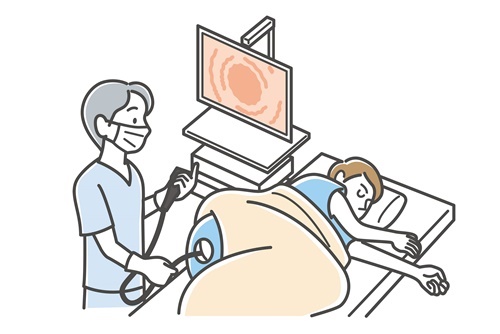 大腸カメラ検査 眠ったまま
